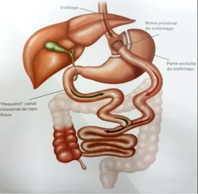 BYPASS-GASTRICO