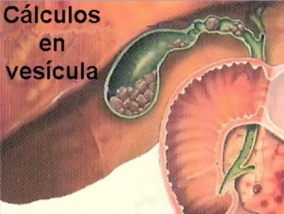 COLELITIASIS