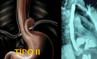 HH Tipo II
