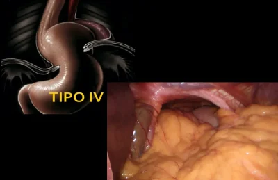 HH Tipo IV