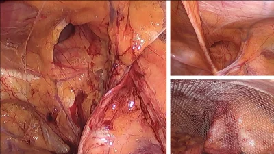 Herniorrafia Ing LPX