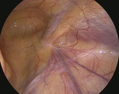 LPX Inguinal