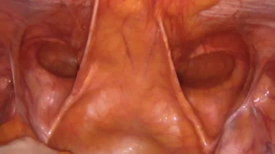 M3P BILATERAL